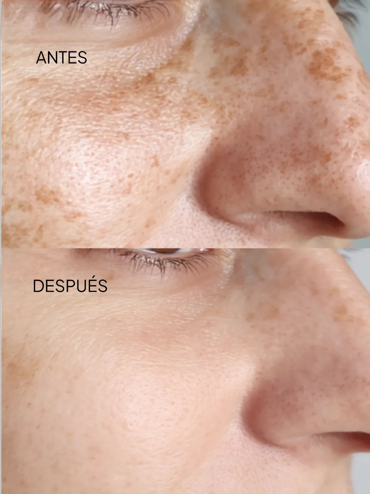 Manchas, Acné, Melasma