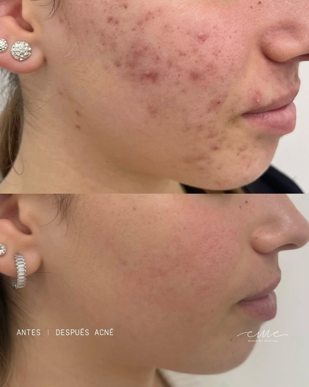Calm Skin - Acné