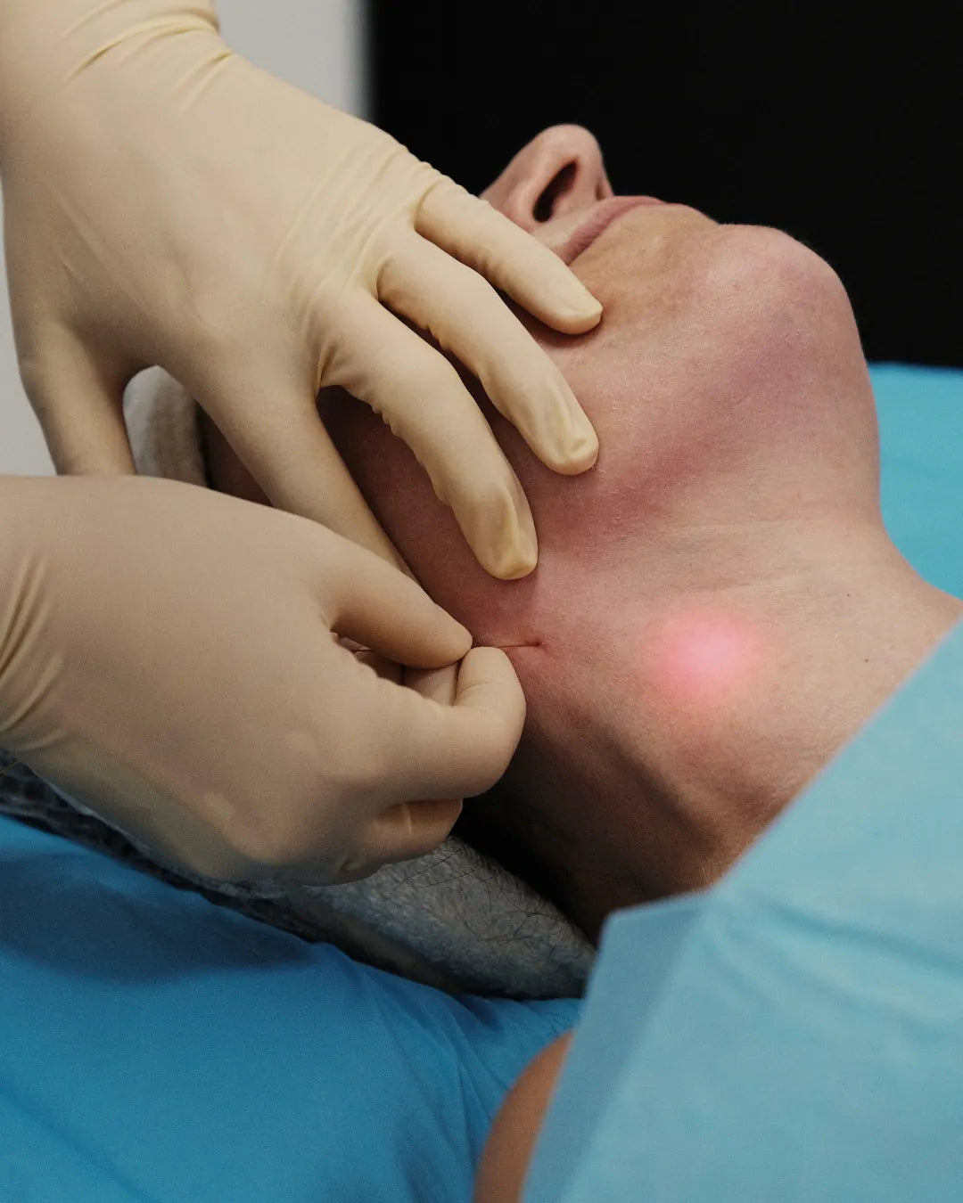 Endosculpt Endolift