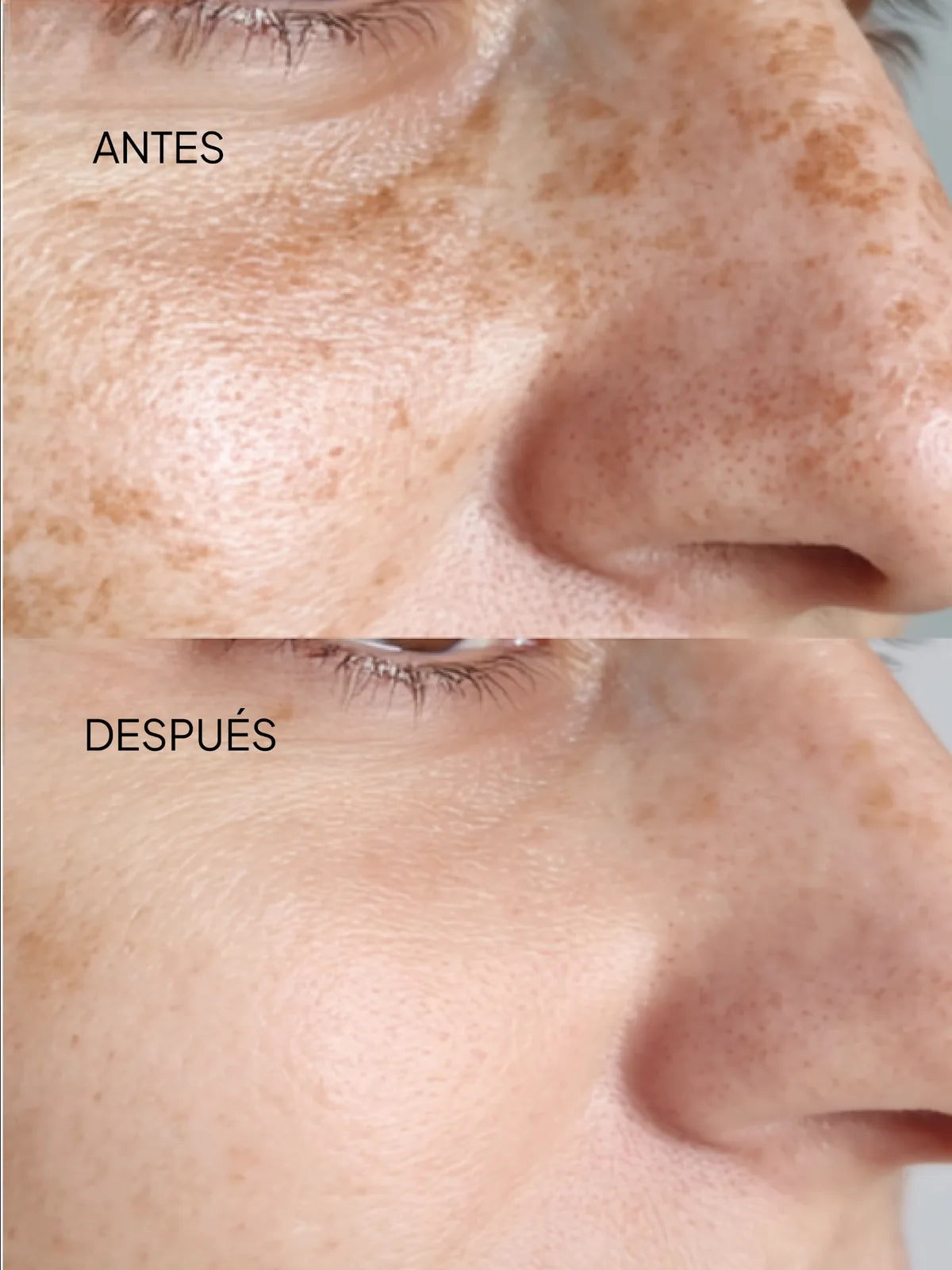 Pigment - Manchas en la piel y melasma