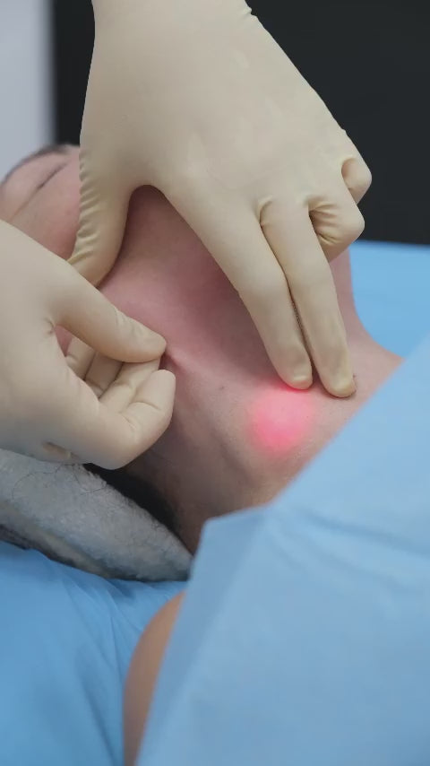 Endosculpt Endolift
